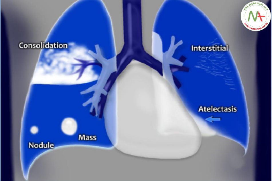 Hình mờ bất thường ở phổi