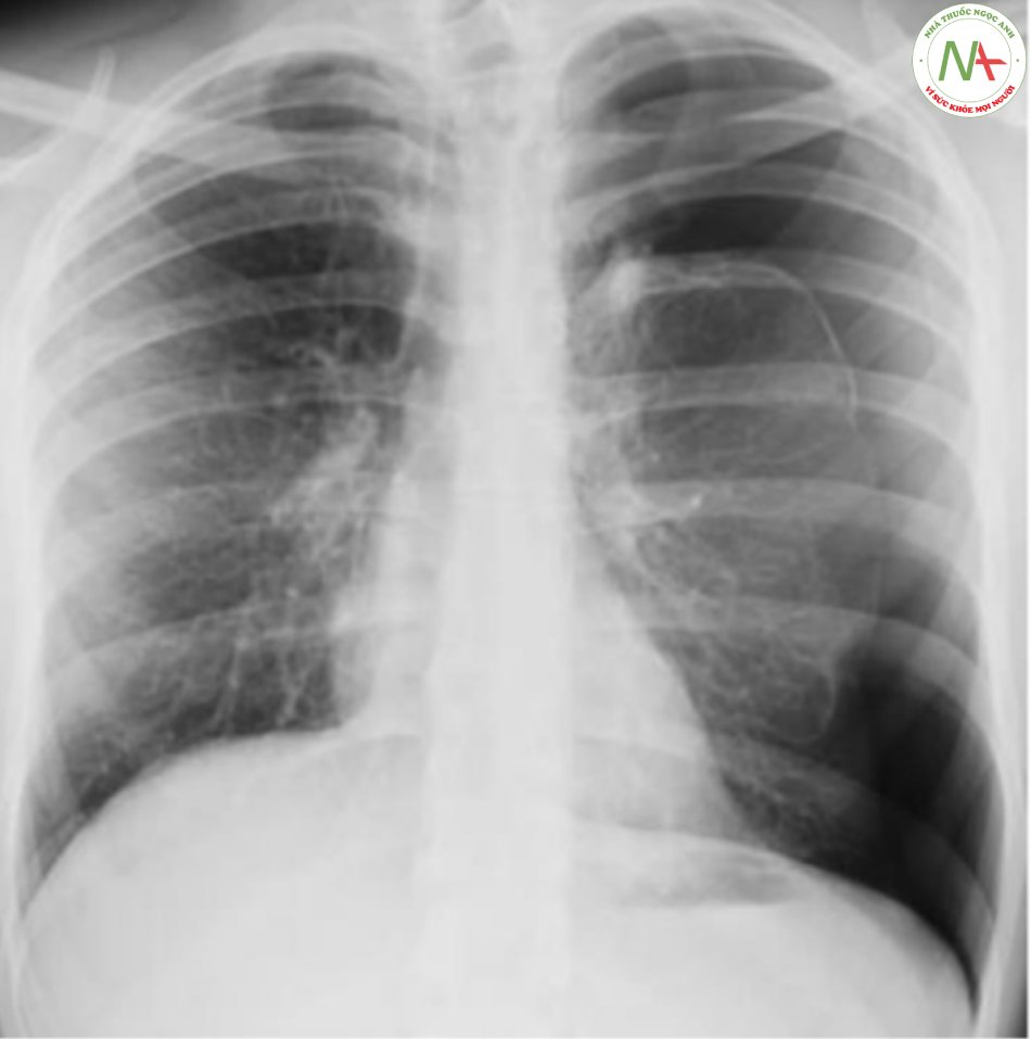 Hình tràn khí màng phổi