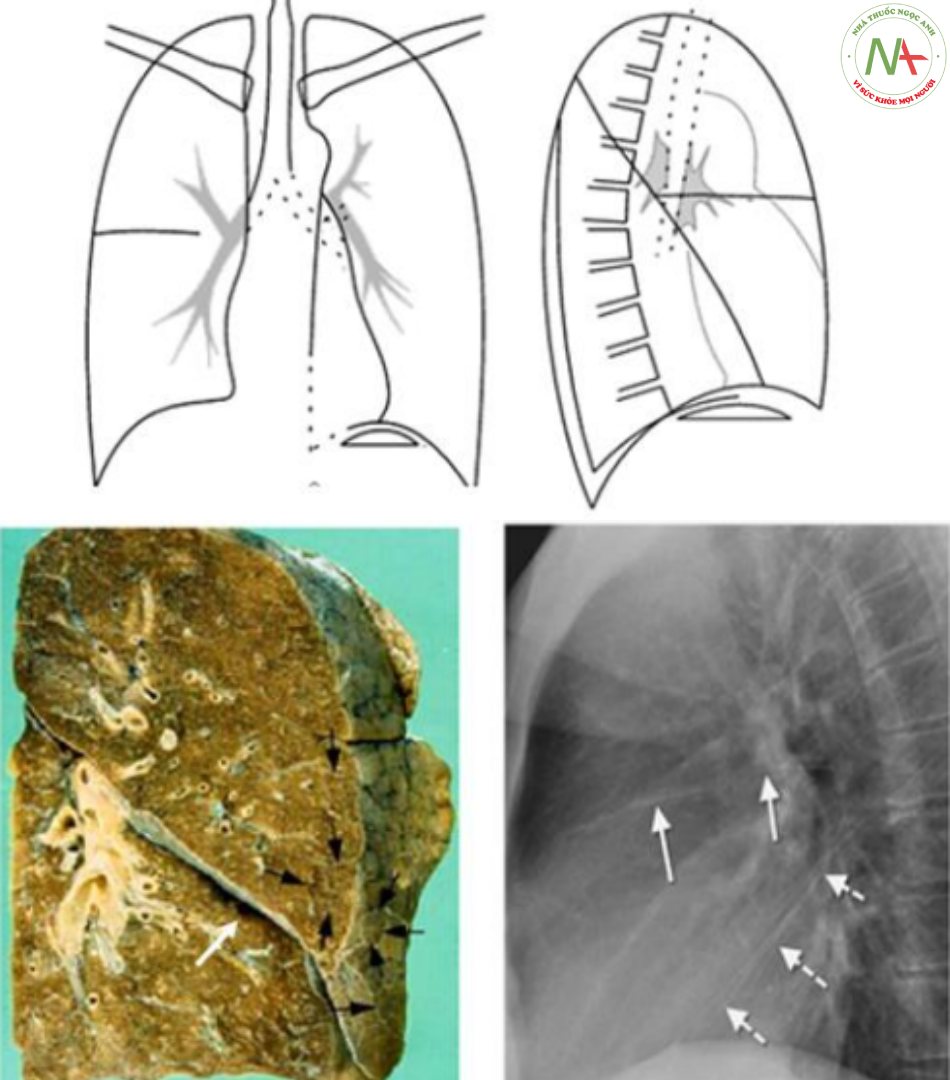 Màng phổi, rãnh liên thùy, mô kẽ quanh tiểu thùy phổi cấp 2là các cấu trúc liên tục 