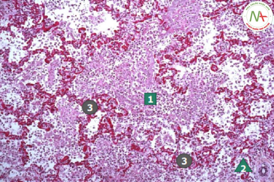 Mờ dạng đông đặc (consolidation) và phế quản hơi (airbronchogram) = Lấp đầy phếnang (alveolar filling) không đồng nhất (2) nhưng còn hình ảnh của phế quản (2) và mô kẽ quanh phế nang bị dầy lên (3)