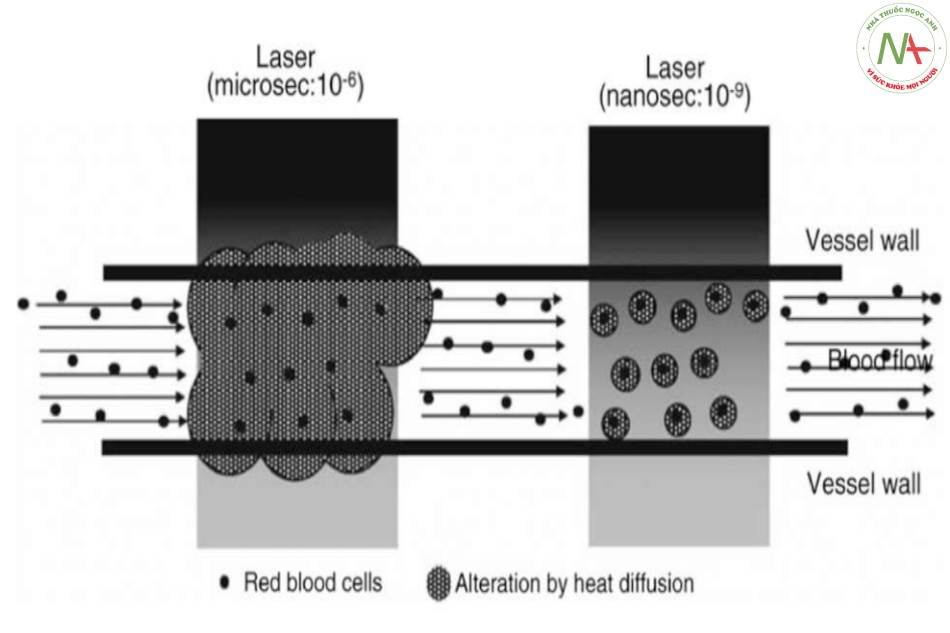 Một lược đồ cho thấy sự khác biệt trong điều trị các tổn thương mạch máu giữa laser xung dài (micro giây) và ngắn (nano giây)