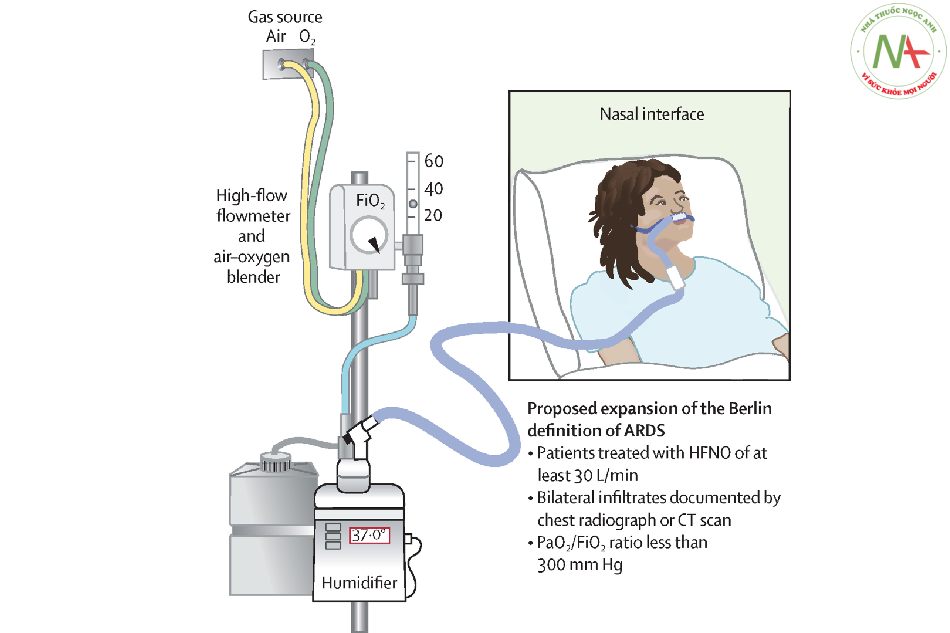 Sử dụng oxy mũi lưu lượng cao (HFNO)