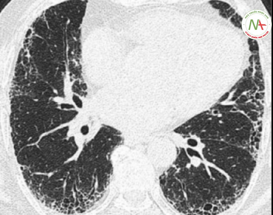 Xơ hóa mô kẽ dưới màng phổi
