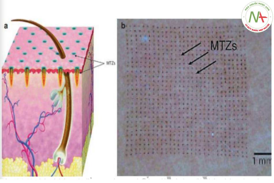 (a) Hình minh họa các điểm MTZ bao quanh bởi mô bình thường. (b) Hình ảnh lâm sàng các điểm MTZ bao quanh bởi mô bình thường.