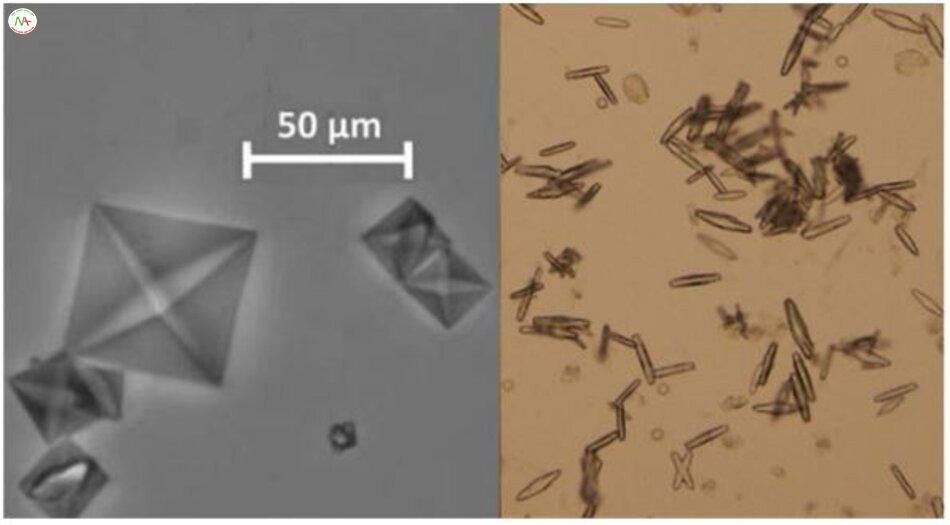 Hình 3. Photomicrographs các tinh thể calcium oxalate điển hình trong nước tiểu. Trái: dạng cổ điển “back of envelope” tinh thể calcium oxalate. Phải: các tinh thể dày hình kim, thường gặp hơn. Left photomicrograph repro- duced from Daudon and Frochot 2015 (Clin Chem Lab Med. https://doi.org/10.1515/cclm-2015-0860) with permission of the copyright holder; original image © 2015 Walter de Gruyter and Company.