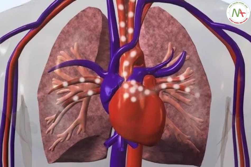Biến chứng phổi thường gặp sau phẫu thuật tim
