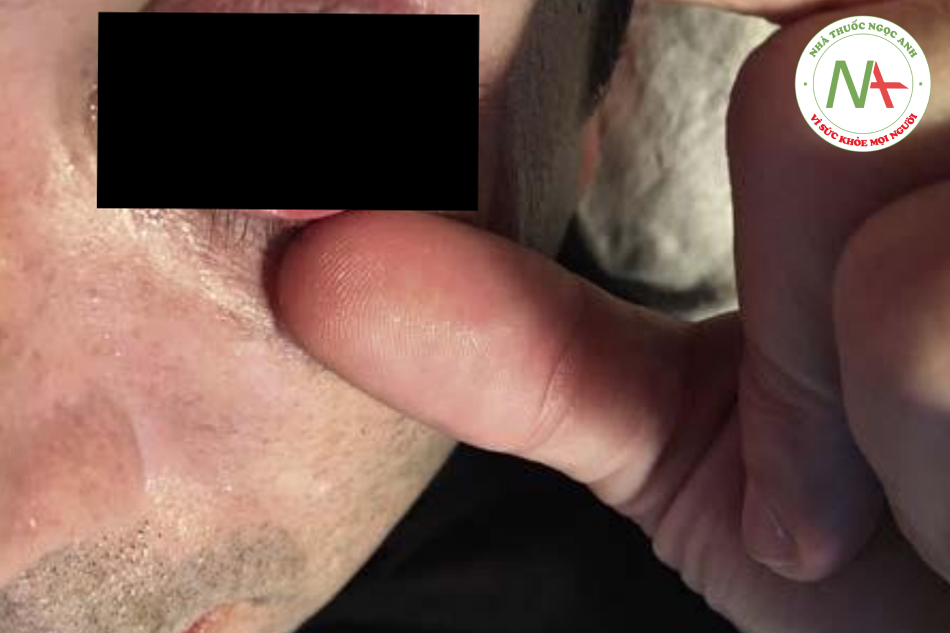 Hình. 16.11 Tổn thương mắt sau peel da mặt và mắt bằng axit trichloroacetic. Xuất hiện dải đông tụ protein (sương trắng) trên đường nhỏ TCA quanh ổ mắt. (Ảnh: Tiến sĩ Joe Niamtu.)