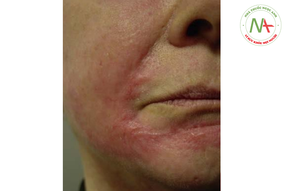 Hình. 16.7 Sẹo phì đại sau khi liệu trình peel TCA (mặt) và mài mòn da (quanh miệng). Mặc dù không có thông tin chi tiết về quá trình thực hiện thủ thuật này, nhưng khả năng sẹo hình thành là do mài mòn da quá sâu hoặc hoạt chất peel xâm nhập được vào vùng da đã mài mòn