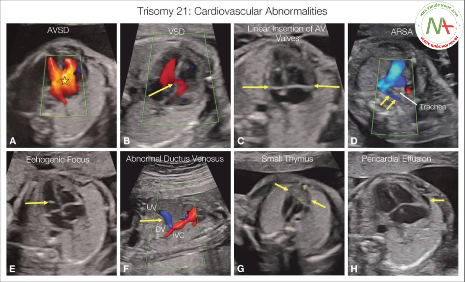 Hình 2.2: Các bất thường tim mạch ở thai nhi trisomy 21