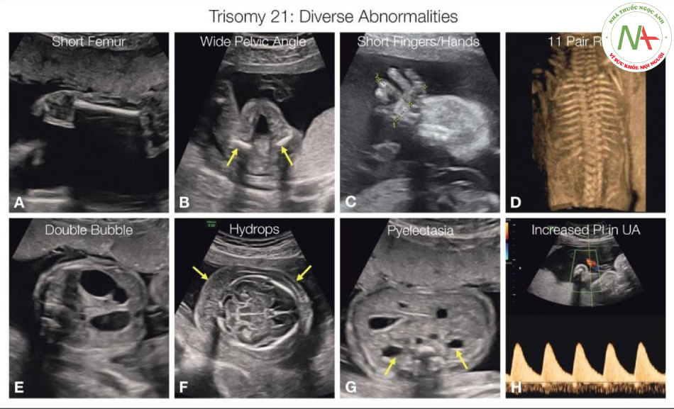 Hình 2.3: Thai nhi trisomy 21 có thể có các bất thường đa dạng bao gồm cả hệ xương