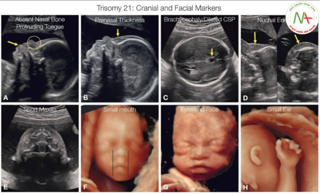 Hình 2.4: Các dấu hiệu sọ và mặt ở thai nhi trisomy 21