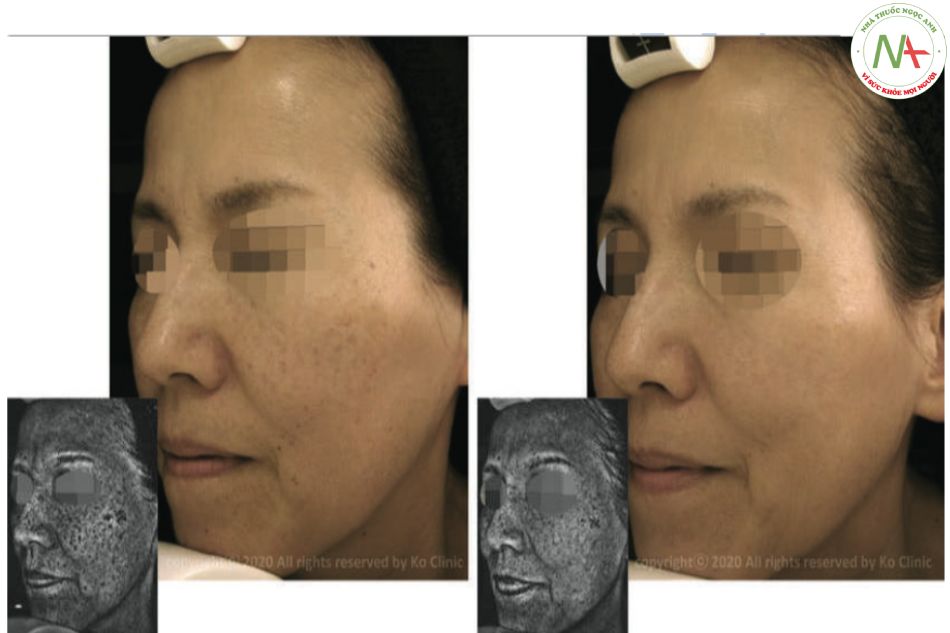 Hình 4 Hình ảnh trước và sau điều trị tổn thương sắc tố với Laser 755 pico giây. Laser sử dụng: Picowon, WONTECH Co. Ltd. Daejeon, Korea. Hình ảnh do Ko clinic,Nhật Bản cung cấp