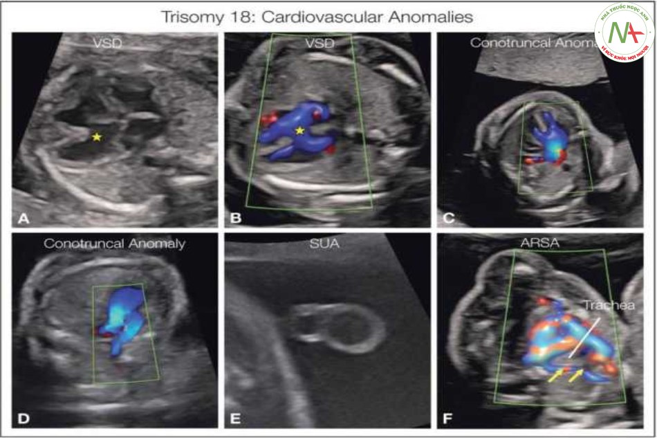 Hình 5: Các bất thường tim mạch ở thai nhi bị Trisomy 18