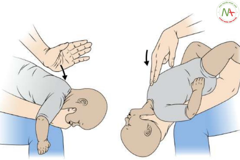 Hình 7. Giảm nghẹt thở cho trẻ sơ sinh