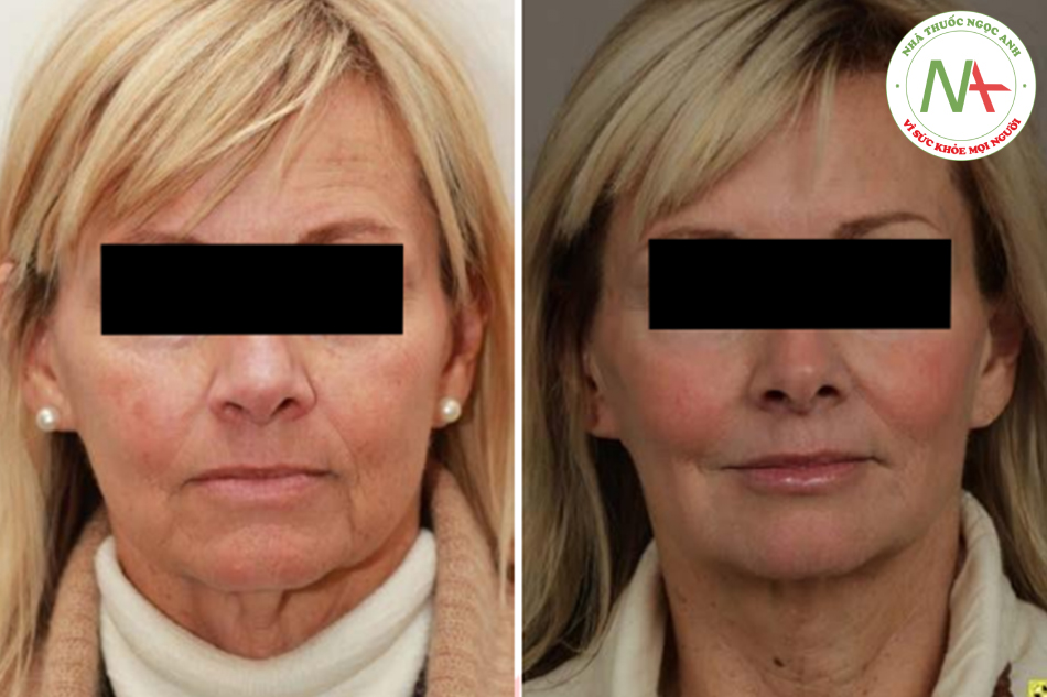 Hình. 7.13 Người phụ nữ 63 tuổi với những biểu hiện lão hóa rõ. Hình trước và 4 tháng sau khi peel