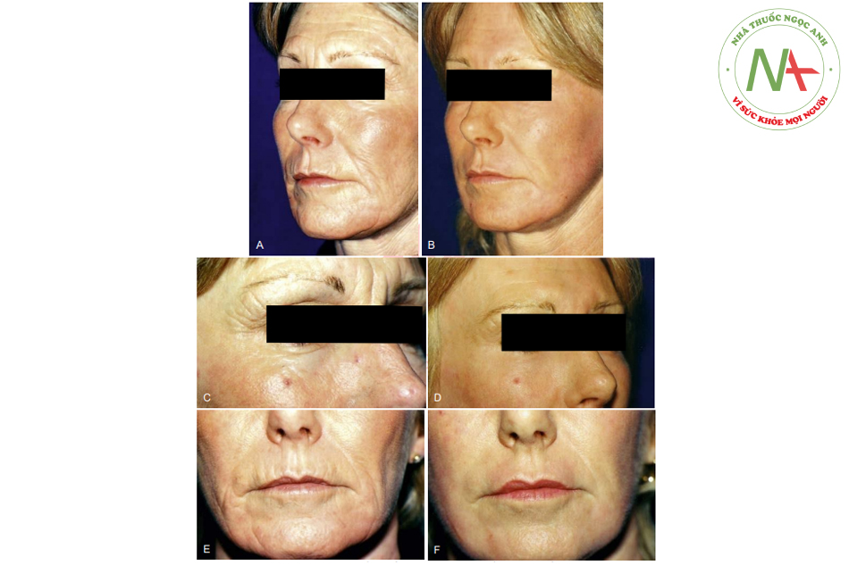Hình. 7.15 A, Một người phụ nữ 49 tuổi có nếp nhăn sâu, giảm đàn hồi da và các nếp nhăn của người hútthuốc. B, Postpeel 8 tháng. Chủ ý thấy cải thiện chất lượng của da và giảm các nếp nhăn chính. C, Prepeel và, D, postpeel của vùng ổ mắt và gian mày. Da mi trên co lại rõ và cải thiện các nếp nhăn sâu. E, Prepeel và F, postpeel của khu vực quanh miệng. 