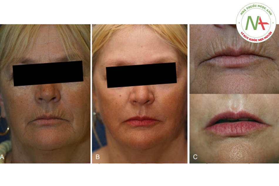 Hình. 7.17 A, Một người phụ nữ 59 tuổi với tình trạng sạm da, xỉn màu do tác hại của ánh nắng mặt trời và các nếpnhăn rõ ở môi trên. B, Postpeel một năm cho thấy sự cải thiện tổng thể và, C, hiệu quả xóa bỏ hoàn toàn các đường nhăn quanh miệng.
