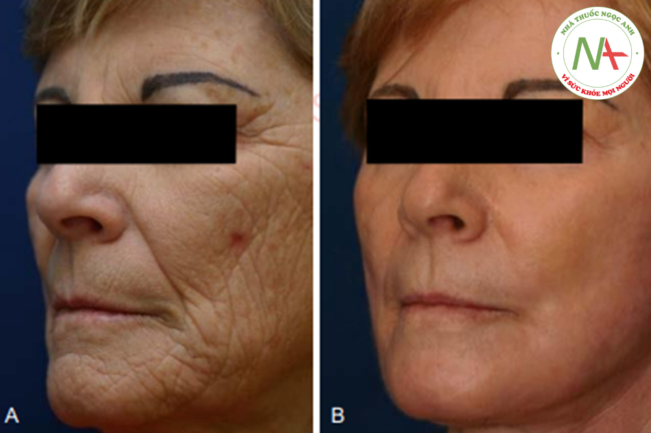 Hình. 7.18 A, Một phụ nữ 65 tuổi có với biểu hiện lão hóa kết cấu da là chính. Tái tạo bề mặt được ưu tiên hơn so vớichỉnh sửa phẫu thuật. B, Postpeel một năm với vẻ ngoài được cải thiện đáng kể và rối loạn sắc tố đã được điều trị.
