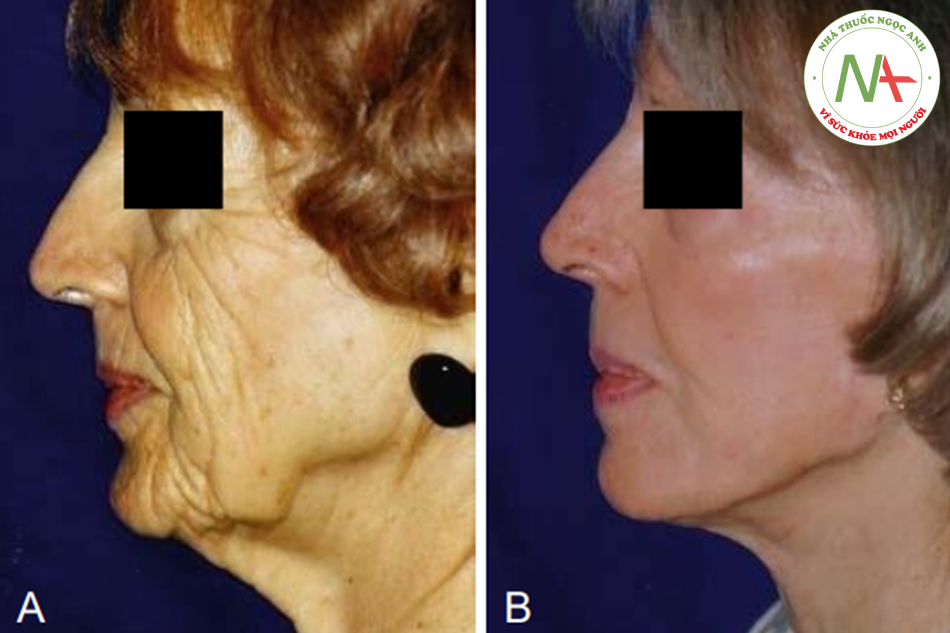 Hình. 7.19 A, Một phụ nữ 75 tuổi bị lão hóa đáng kể về cấu trúc và kết cầu da. B, Kết quả ở tuổi 81, 5 năm saukhi căng da mặt và 1 năm sau peel, thể hiện giá trị của việc kết hợp các phương pháp trẻ hóa