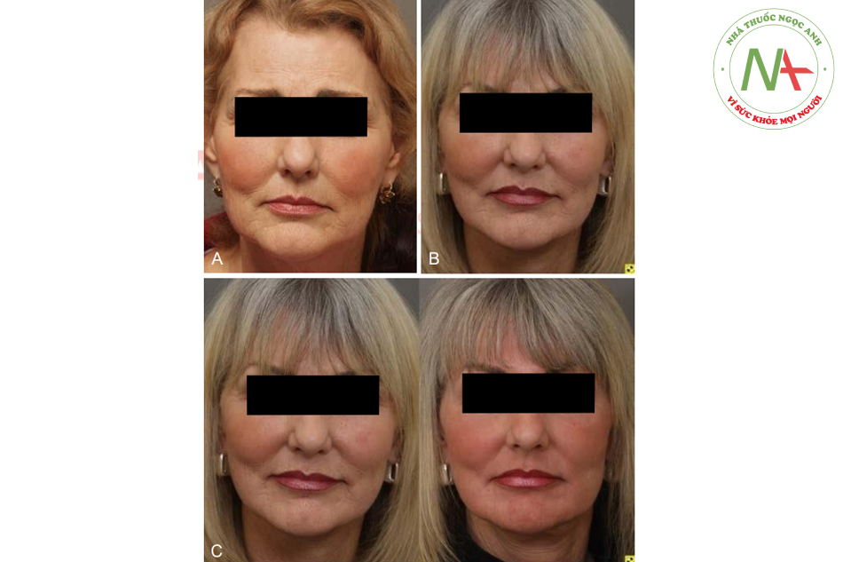 Hình. 7.20 A, Một phụ nữ 63 tuổi có cả ba biểu hiện của lão hóa da mặt: chảy xệ điển hình, jowling và nếpnhăn. B, Một năm sau căng da mặt và ghép mỡ mặt với sự cải thiện đáng kể về cấu trúc và thể tích. C, Một năm rưỡi postpeel. Sự cải thiện của kết cấu và nếp nhăn là yếu tố kết nối mọi thứ với nhau để tạo nên kết quả toàn diện.