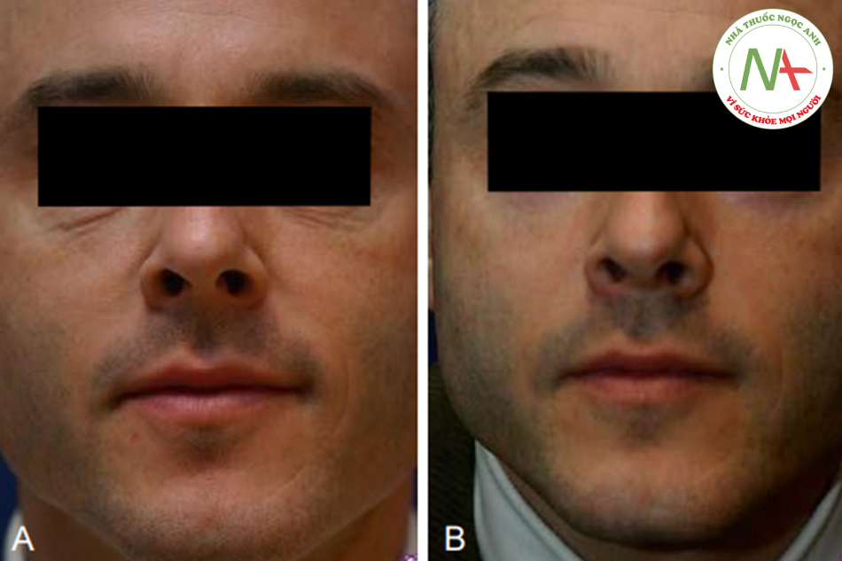 Hình. 7.21 A, Một người đàn ông 44 tuổi có lão hóa da, chủ yếu là sự xuất hiện nếp nhăn và chảy xệ da midưới. B, Sáu tháng sau peel da mi dưới. Phần da này đã cải thiện đáng kể mà không thay đổi hình dáng góc mắt ngoài. 
