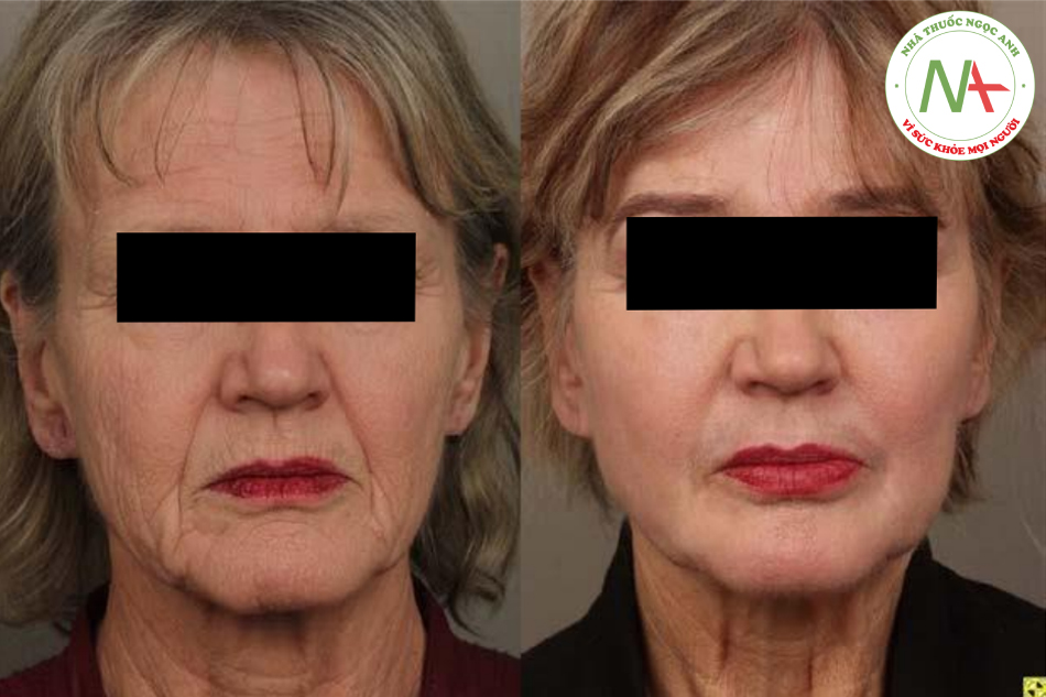 Hình. 7.23 Bên trái, một người phụ nữ 69 tuổi với khuôn mặt nhăn nheo và chảy xệ nhưng không muốnphẫu thuật. Bên phải, 14 tháng sau khi làm đầy mặt bằng microfat và nanofat cùng với peel. Đây là một ví dụ về trẻ hóa vùng mặt ấn tượng mà không cần phẫu thuật