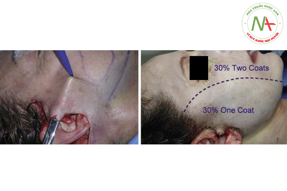 Hình. 14.10 Hình ảnh bên trái các vạt da bóc tách được đánh dấu để phân định giữa vùng được và không được phẫu thuật. Hình bên phải cho thấy vùng trung tâm hình oval (không can thiệp phẫu thuật) được peel bằng 2 lớp TCA 30%, còn vùng can thiệp thì chỉ được peel bằng 1 lớp