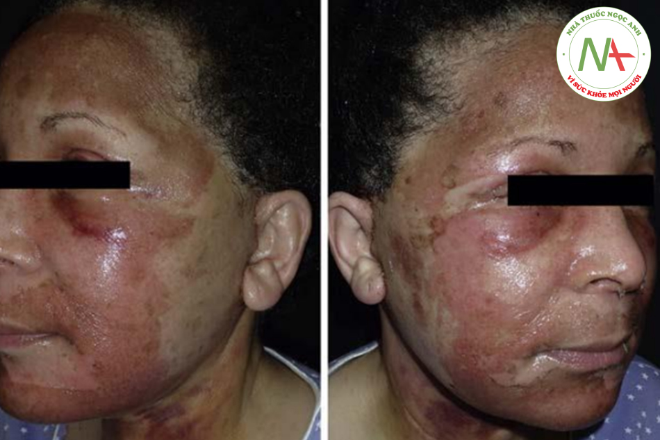 Hình. 14.12 Bệnh nhân: 5 ngày sau khi căng da mặt kết hợp với peel TCA 30% (2 lớp) ở vùng trung tâm và cũng 2 lớp TCA 20% ở vùng có can thiệp phẫu thuật