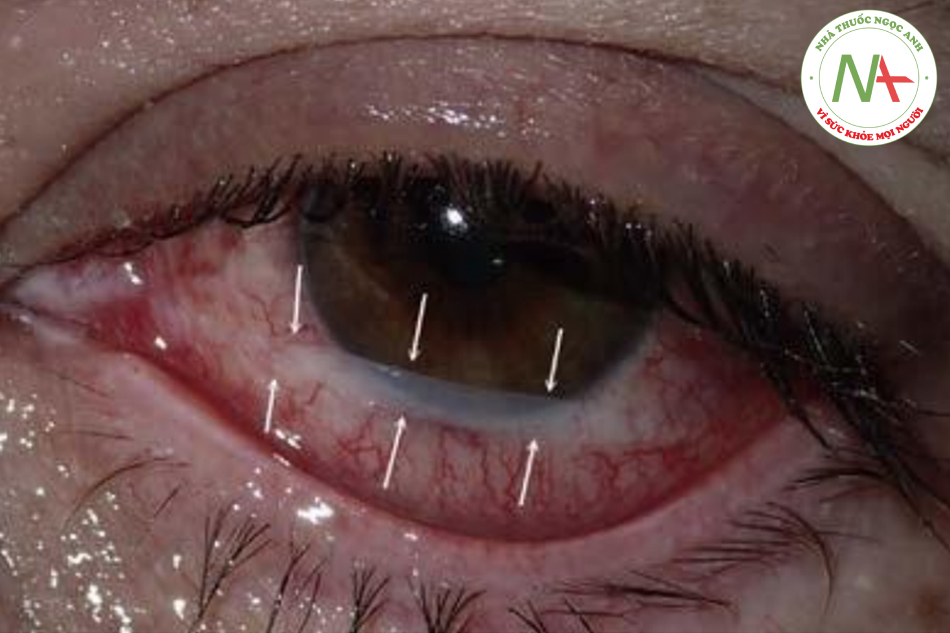 Hình. 14.21 Bệnh nhân này được đưa ra ngoài ngay sau khi lột da bằng axit trichloroacetic 30%, trong đó một phần axit đã chạm đến rìa mí mắt dưới và làm mờ một dải giác mạc. Mắt bị đau và khó chịu nhưng không hề lành lặn
