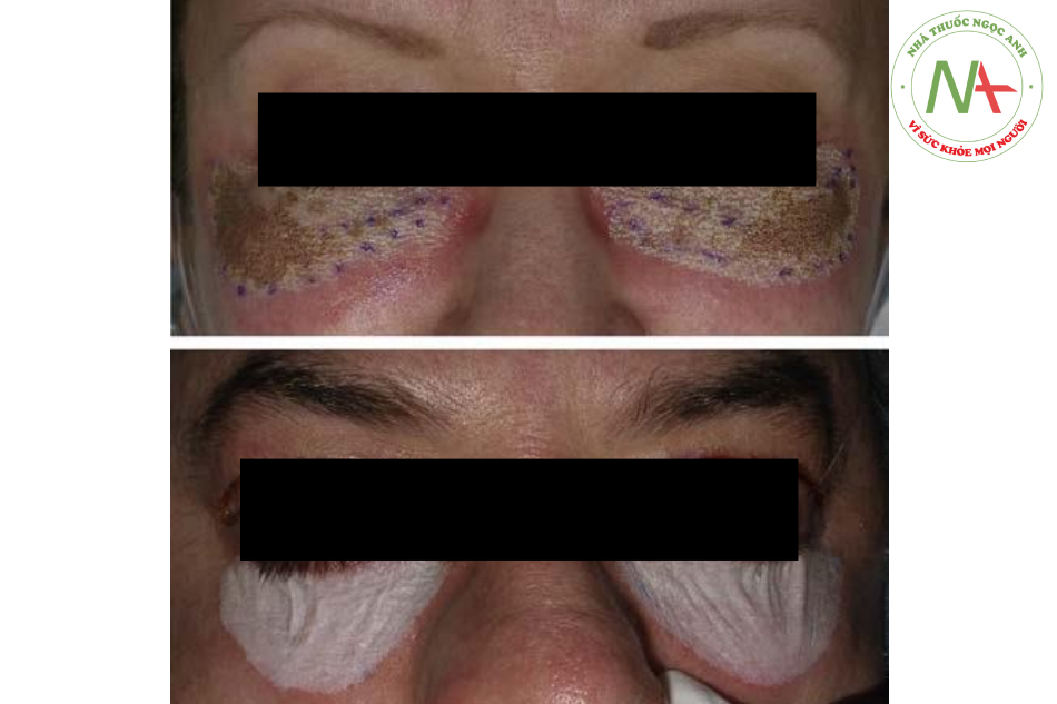 Hình. 14.3 Tái tạo bề mặt bằng laser CO2 (trên cùng) và peel bằng TCA (dưới) là phương pháp điều trị chính để trẻ hóa mí mắt khi thực hiện phẫu thuật tạo hình mi dưới đường kết mạc