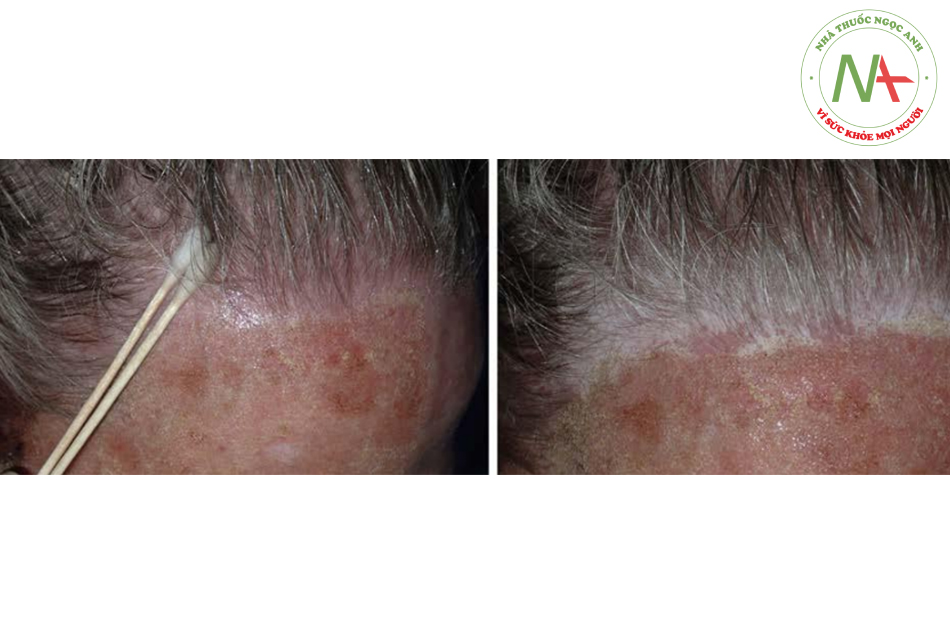 Hình. 14.8 Hình ảnh này mô tả sự kết hợp giữa laser CO2 toàn mặt với peel hóa chất ở đường chân tóc để tránh bất đồng màu da