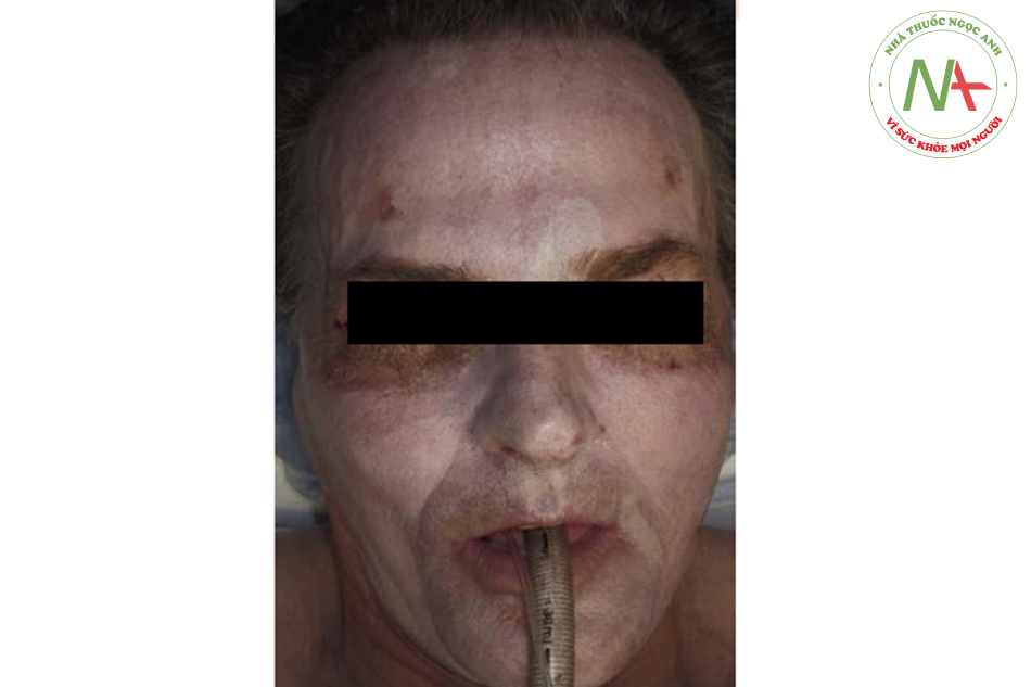Hình. 14.9 Bệnh nhân này đã được thực hiện phẫu thuật tạo hình mi dưới và peel toàn mặt. Bởi vì mi dưới bị chảy xẹ đáng kể, BS đã chỉ định điều trị bằng laser CO2 trên khu vực này