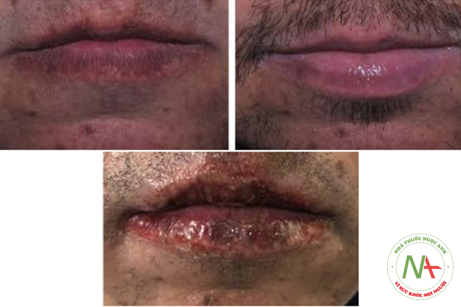 Hình. 15.10 Trước, sau 7 ngày và 3 ngày sau peel môi với mục đích cải thiện đường viền môi ở một bệnh nhân nam với công thức Hetter heavy: 1 mL phenol 88% + 3 mL dd Hetter + 0,5 mL Novisol Cleanser + 5,5 mL nước cất
