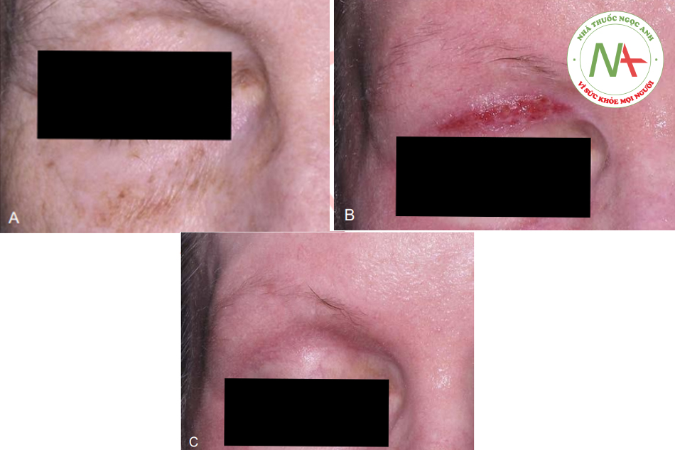 Hình. 15.3 Hình ảnh sau peel quanh mắt ở một bệnh nhân peel toàn mặt bằng 1,6% dầu croton trong 35% phenol. A, Trước peel. Cố tình peel tập trung vào vùng mi trên để tạo ra hiện tượng co kéo (mô cũng lâu lành hơn). B, Sau thủ thuật ngày thứ 10 (POD). C, Không thấy sẹo tại ngày thứ 30 sau thủ thuật