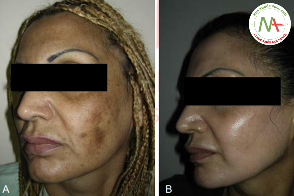Hình. 8.10 Một bệnh nhân da ngăm đen trước (A) và 6 tháng sau (B) peel.