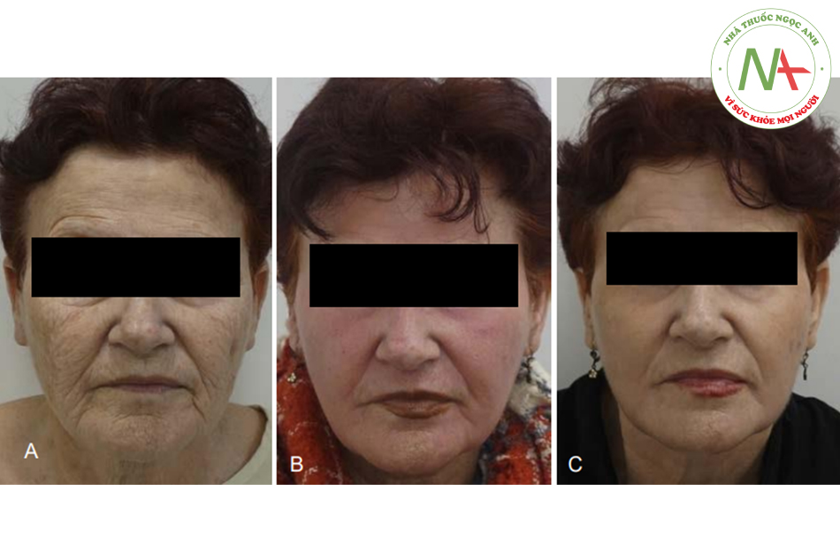 Hình. 8.7 Một bệnh nhân 69 tuổi trước (A), 10 ngày sau (B) và 3 tháng sau (C) thủ thuật.