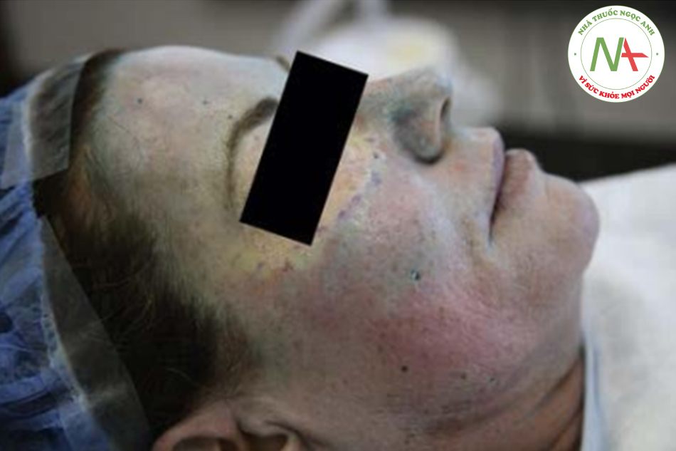 Hình. 5.11 Bệnh nhân đã được thực hiện peel axit trichloroaceticBlue peel toàn mặt kèm theo feathering quanh mặt. Sau đó, da được làm sạch, đeo dụng cụ bảo vệ mắt và thực hiện tái tạo bề mặt da quanh hốc mắt bằng laser CO2 fractional