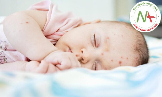 Sử dụng kháng sinh trong các bệnh nhiễm khuẩn da và mô mềm ở trẻ em