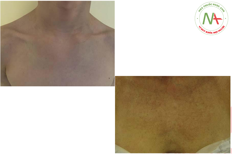 Hình. 6.1 So sánh giữa da vùng ngực “trẻ trung” (trên) với ngực“trưởng thành” (dưới) cho thấy những thay đổi do lão hóa, ánh nắng mặt trời và các yếu tố môi trường