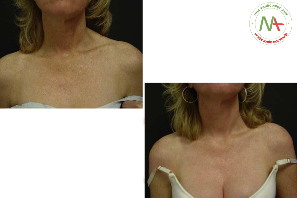 Hình. 6.8 Trước và sau Blue Peel TCA vùng ngực