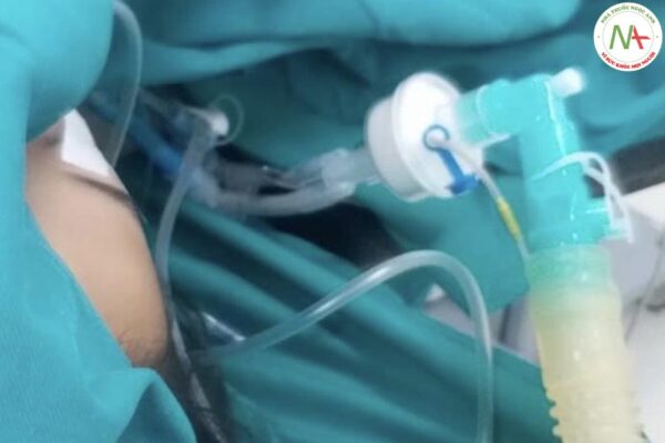 thông khí bảo vệ phổi cho bệnh nhân phẫu thuật