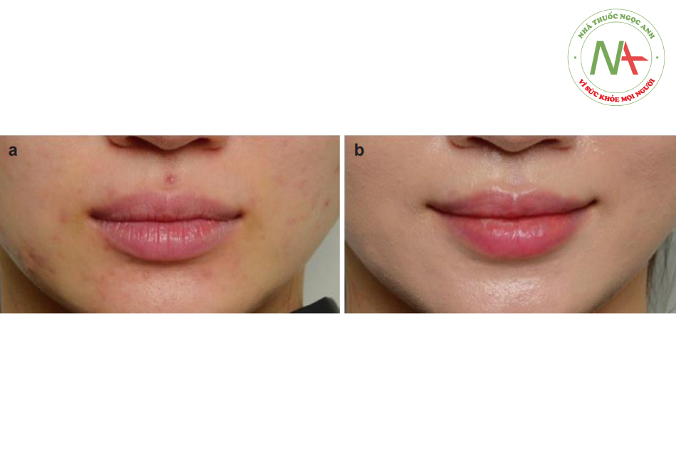 Hình. 9.24 Ảnh chụp gần của môi (a) trước và (b) sau thủ thuật
