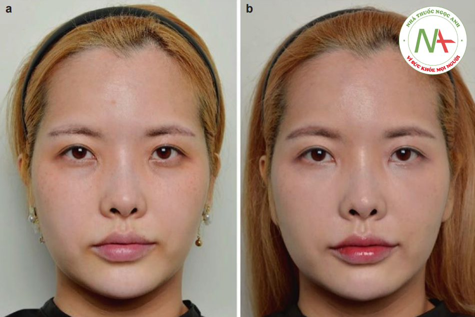 Hình. 9.25 Một bệnh nhân nữ 29 tuổi được nâng khoé miệng (a) Góc mặt nhìn thẳng trước thủ thuật và (b) Góc mặt nhìn thẳng 2 tuần sau thủ thuật. Vùng rãnh lệ cũng đã được làm đầy