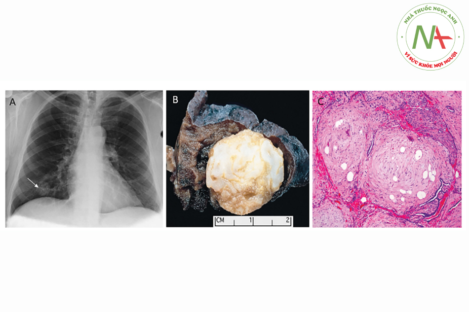 Hình 13.1. U hamartoma trên đường hô hấp dưới. A). Trên X-quang ngực. B). Đại thể: Cấu trúc phổi xung quanh tách rời khối u có ranh giới rõ, đây là hình ảnh điển hình u loại này. Khối u có màu vàng, trắng ngà, tương ứng với màu mô mỡ và sụn. C). Vi thể: Tổn thương không có trung tâm, không hoại tử và không tăng hoạt động phân bào.