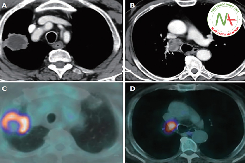 Hình 13.4. Hình CT scan ngực cản quang (hình trên) và PET- CT (hình dưới).