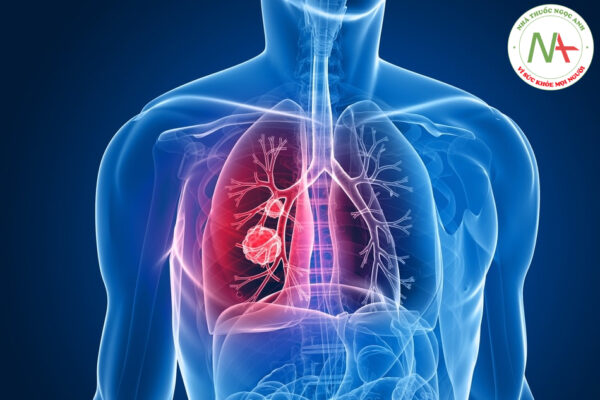 Chẩn đoán U phổi qua các đặc điểm và biểu hiện lâm sàng