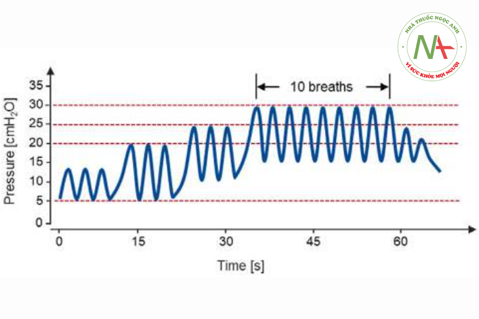 HÌNH 3 Sơ đồ minh họa diễn biến của áp lực đường thở trong thủ thuật huy động phổi được áp dụng trong nghiên cứu của Acosta và đồng nghiệp ở 42 trẻ từ 6 tháng đến 7 tuổi có phổi khỏe mạnh, trước khi bơm CO2 vào khoang phúc mạc.15 Trong quá trình thông khí kiểm soát áp lực, áp lực đẩy được tăng lên 15 cmH2O, sau đó, PEEP được tăng lên 10 cmH2O và 15 cmH2O liên tiếp, mỗi điều kiện áp dụng cho 3 nhịp thở liên tiếp. Ở PEEP 15 cmH2O và áp lực đẩy 15 cmH20,10 nhịp thở được áp dụng với hiệu quả của thủ thuật kiểm soát qua siêu âm phổi