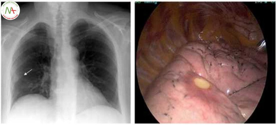 Hình 2. Tổn thương nốt giun chỉ Dirofilariasis trên X-quang ngực và trên phổi qua nội soi lồng ngực