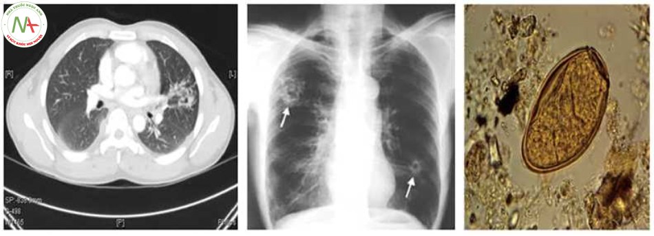 Hình 3 Tổn thương phổi do sán lá Paragonimus trên CT scan và X-quang ngực và trứng sán trên bệnh phẩm đờm