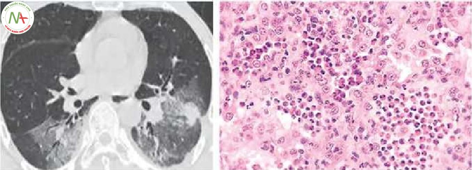 Hình 4 Thâm nhiễm Loeffler do Ascaris phổi 